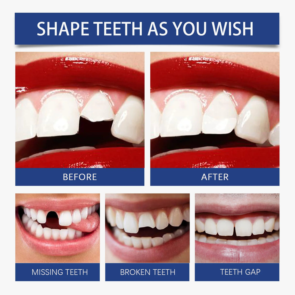 Oralhoe Resin Tooth Repair Glue – Shapeable DIY Temporary Tooth Filling & Gap Repair Kit